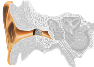 Audífonos IIC en SonoClinic