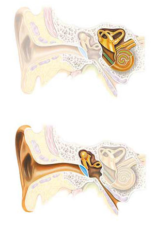 Tipos de Pérdida Auditiva